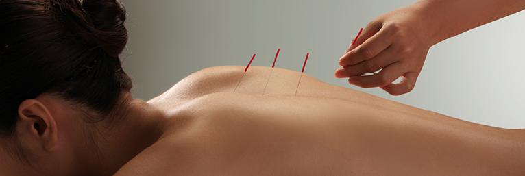Akupunktúrás tűk SEIRIN