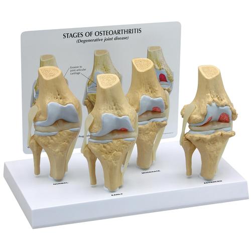Conjunto de modelo de rodilla osteoartrítica, 4 fases, 1019502, Modelos de Articulaciones