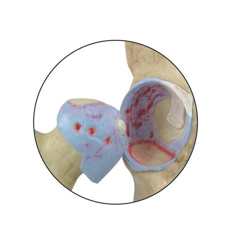 Patologie di degenerazione ossea del modello di anca (4 stadi), 1019506, Modelli di Pelvi e Organi genitali