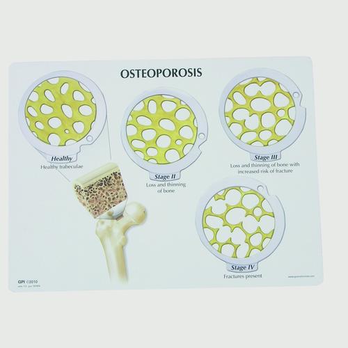 Knochenkrebs­Scheibenset - 4 Stadien der Osteoporose, 1019509, Wirbelmodelle
