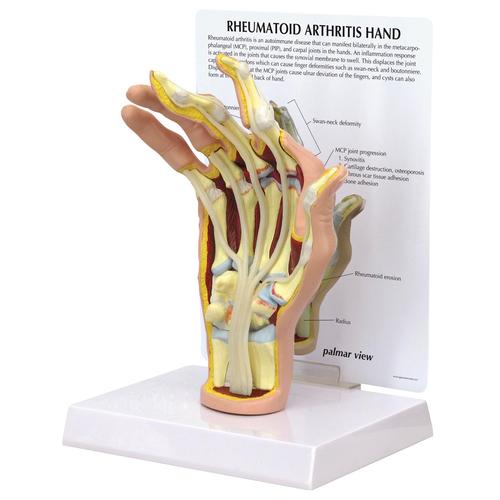 Mod&egrave;le de main avec arthrite rhumato&iuml;de, 1019521, Squelettes des membres sup&eacute;rieurs