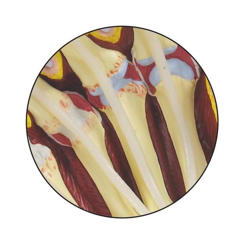 Handmodell mit rheumatoider Arthritis, 1019521, Hand- und Armskelett Modelle