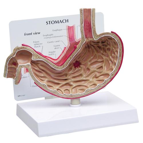 Modèle d’estomac avec ulcères, 1019523, Modèles de systèmes digestifs