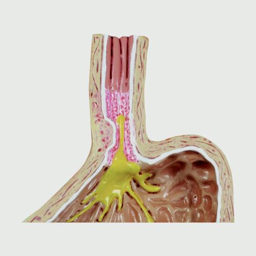 ГЭРБ (Гастроэзофагеальная рефлюксная болезнь), 4 части, 1019525, Модели пищеварительной системы человека