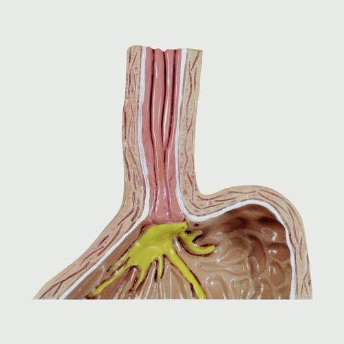 胃食管反流病4阶段展示模型, 1019525, 消化系统