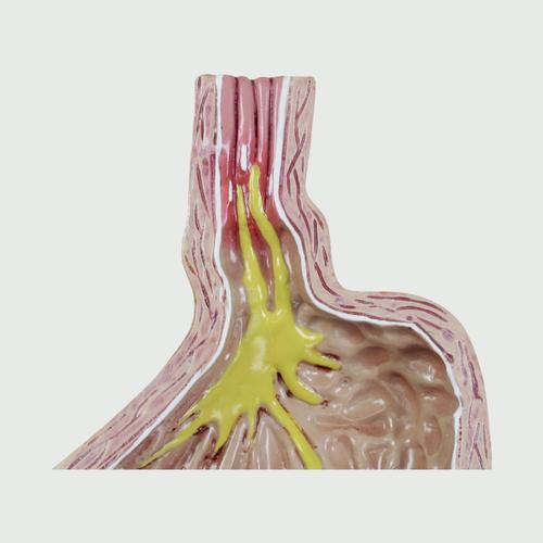 ГЭРБ (Гастроэзофагеальная рефлюксная болезнь), 4 части, 1019525, Модели пищеварительной системы человека