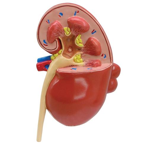Modelo de riñón enfermo, 1019550, Modelos del Sistema Digestivo