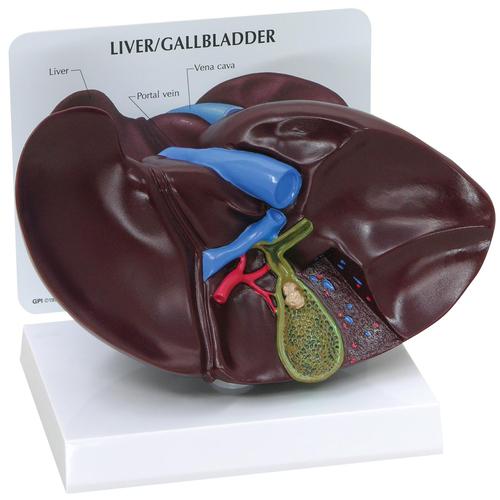 肝脏-胆囊模型-带胆结石症状, 1019551, 消化系统