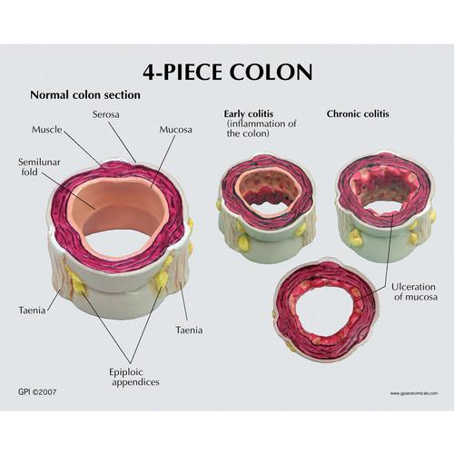 4 Piece Colon with Pathologies, 1019555, Digestive System Models