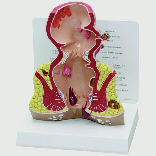 Coupe du rectum (agrandie) avec pathologies, 1019557, Modèles de systèmes digestifs