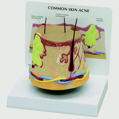 Modèle d’acné cutanée (agrandi), 1019567, Modèles de dermes