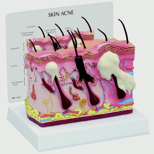 Skin Acne Model, 2 Sided, 1019568, Skin Models