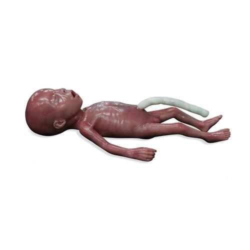 Bebé microprematuro / Pretérmino de peso extremadamente bajo al nacer (PEBN)
, 1024668, ALS neonatal
