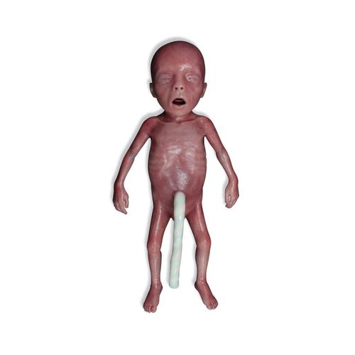 Bébé très grand prématuré / Bébé de très petit poids de naissance
, 1024668, Réanimation ALS nourrisson