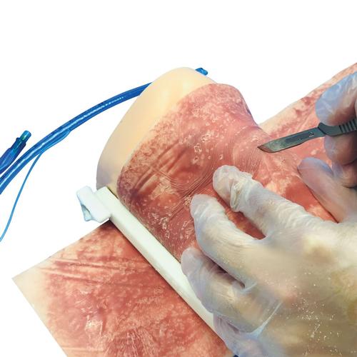 Pele para Cricotireoidotomia com Queimadura devido &agrave; Radioterapia., 1025390, Gest&atilde;o das vias a&eacute;reas adulto
