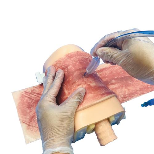 Pele para Cricotireoidotomia com Queimadura devido &agrave; Radioterapia., 1025390, Gest&atilde;o das vias a&eacute;reas adulto
