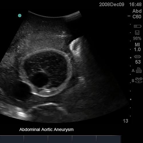 Blue Phantom Abdominal Aortic Aneurysm Ultrasound Training Model, 3012449, Ultrasound Skill Trainers