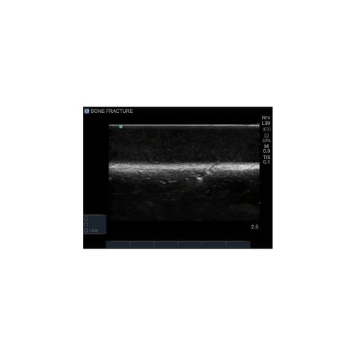 Blue Phantom Bone Fracture Ultrasound Training Block Model - Crepitus, 3012454, Ultrasound Skill Trainers
