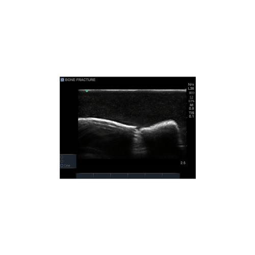 Blue Phantom Bone Fracture Ultrasound Training Block Model - Crepitus, 3012454, Ultrasound Skill Trainers