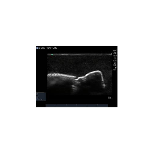 Blue Phantom Bone Fracture Ultrasound Training Block Model - Greenstick, 3012455, Ultrasound Skill Trainers