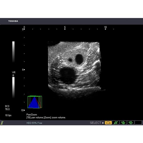 Blue Phantom Combo Intrauterine and Ectopic Pregnancy Transvaginal Ultrasound Training Model, 3012465, Ultrasound Skill Trainers