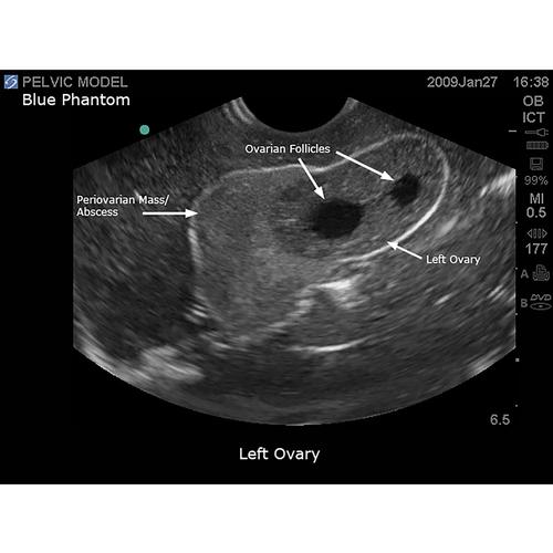Blue Phantom General Pathology Transvaginal Ultrasound Training Model, 3012484, Ultrasound Skill Trainers