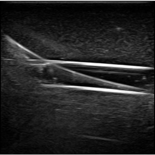 Blue Phantom Gen II PICC with I.V. and Arterial Line Ultrasound Training Model, 3012493, Ultrasound Skill Trainers