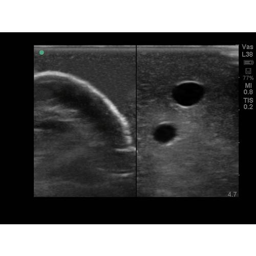 Blue Phantom Internal Jugular Central Line Ultrasound Manikin, 3012495, Ultrasound Skill Trainers