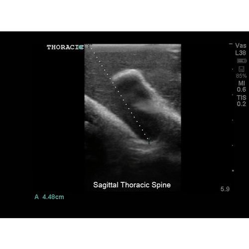Blue Phantom Spinal Epidural and Lumbar Puncture Training Model, 3012516, Ultrasound Skill Trainers