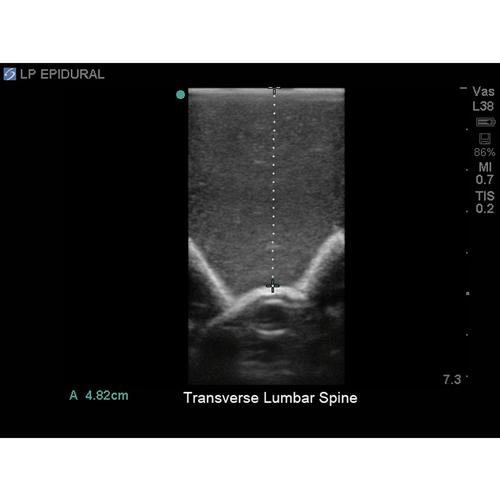 Blue Phantom Spinal Epidural and Lumbar Puncture Training Model, 3012516, Ultrasound Skill Trainers