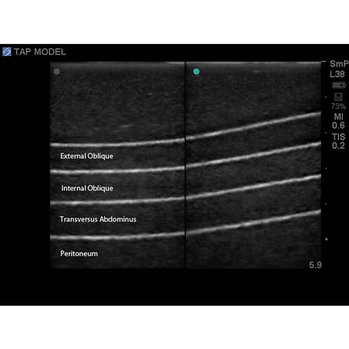 Blue Phantom TAP Block Ultrasound Training Model for Regional Anesthesia, 3012517, Ultrasound Skill Trainers