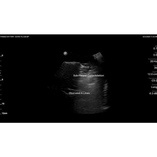 Blue Phantom Live Lung Ultrasound Simulator, 3016096, Cuidado del paciente adulto