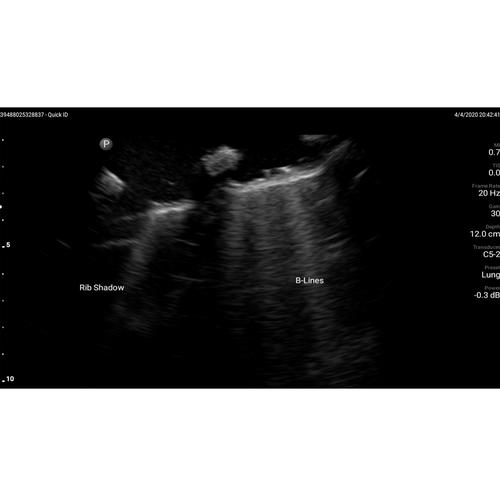 Blue Phantom Live Lung Ultrasound Simulator, 3016096, ALS adulto