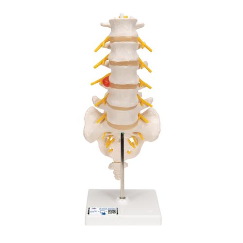 Colonna vertebrale lombare con ernia del disco dorsolaterale - 3B Smart Anatomy, 1000150 [A76/5], Modelli di vertebre