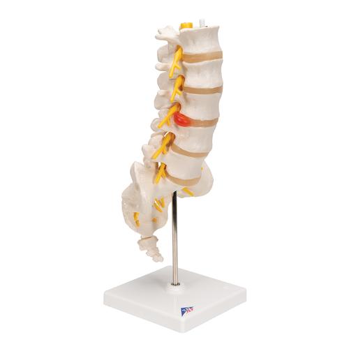 Colonne vertébrale lombaire avec prolapsus dorso-latéral du disque intervertébral - 3B Smart Anatomy, 1000150 [A76/5], Modèles de vertèbres
