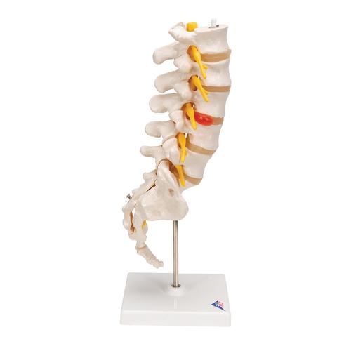 (후외측, 배측방) 디스크 요추모형 Lumbar Spinal Column with Dorso-Lateral Prolapsed Intervertebral Disc - 3B Smart Anatomy, 1000150 [A76/5], 척추뼈 모형