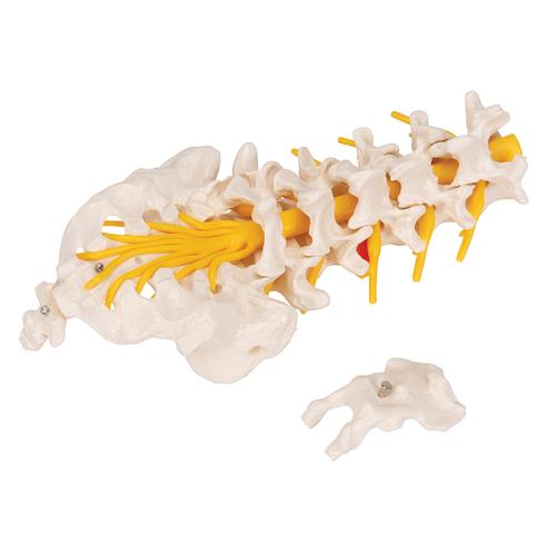 Colonne vertébrale lombaire avec prolapsus dorso-latéral du disque intervertébral - 3B Smart Anatomy, 1000150 [A76/5], Modèles de vertèbres