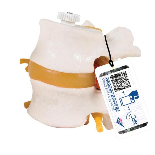유연한 디스크 탈출 요추 모형 2파트  2 Human Lumbar Vertebrae with Prolapsed Disc, Flexibly Mounted - 3B Smart Anatomy, 1000152 [A76/9], 척추뼈 모형