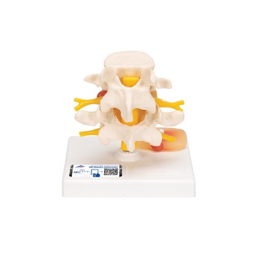 Human Lumbar Spinal Column with Prolapsed Intervertebral Disc - 3B Smart Anatomy, 1000149 [A76], Vertebra Models