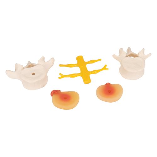 &Aacute;gy&eacute;ki gerincoszlop porckorongs&eacute;rvvel, 1000149 [A76], Csigolyamodellek