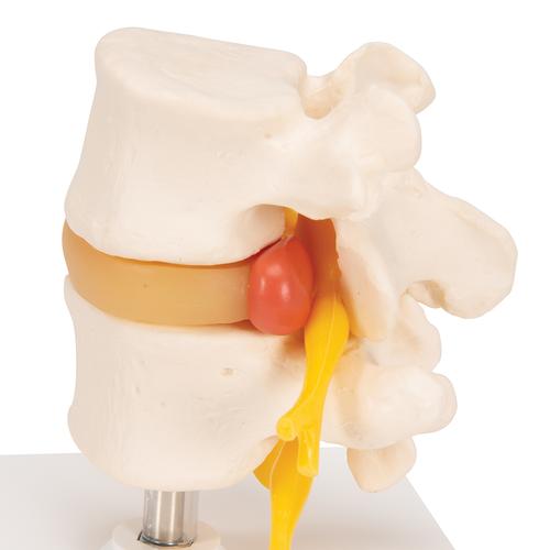 Human Lumbar Spinal Column with Prolapsed Intervertebral Disc - 3B Smart Anatomy, 1000149 [A76], Vertebra Models