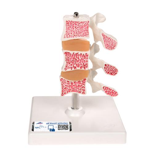 Modèle d’ostéoporose de luxe (3 vertèbres) - 3B Smart Anatomy, 1000153 [A78], Modèles de vertèbres
