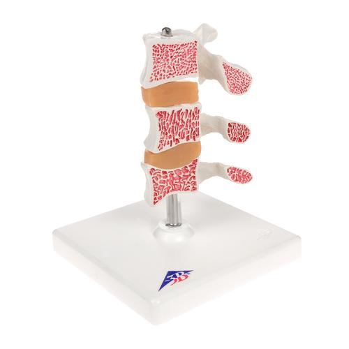 Osteoporose Modell mit 3 Lendenwirbeln, auf Stativ - 3B Smart Anatomy, 1000153 [A78], Wirbelmodelle