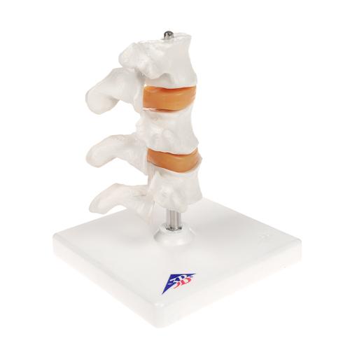 Deluxe Human Osteoporosis Model (3 Vertebrae with Discs ), Removable on Stand - 3B Smart Anatomy, 1000153 [A78], Vertebra Models