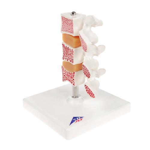 Deluxe Human Osteoporosis Model (3 Vertebrae with Discs ), Removable on Stand - 3B Smart Anatomy, 1000153 [A78], Arthritis and Osteoporosis Education