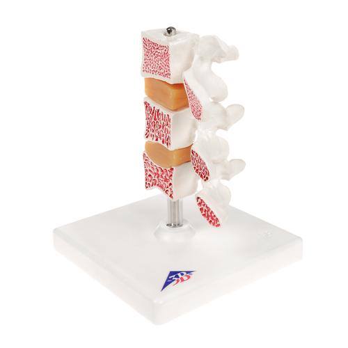 Modelo de osteoporosis &ndash; Versi&oacute;n de Lujo (3 Vertebrales), 1000153 [A78], Modelos de v&eacute;rtebras