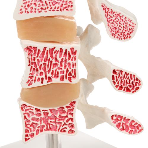 Deluxe Human Osteoporosis Model (3 Vertebrae with Discs ), Removable on Stand - 3B Smart Anatomy, 1000153 [A78], Vertebra Models