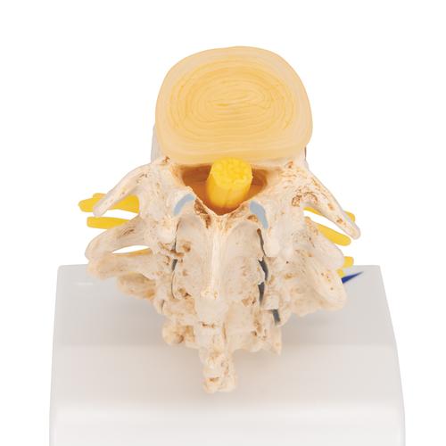Stadi dell’ernia del disco intervertebrale e degenerazione della vertebra - 3B Smart Anatomy, 1000158 [A795], Modelli di vertebre