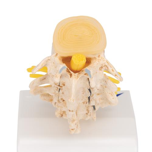 퇴행성 요추와 추간판탈출증 모형 Stages of disc prolapse and vertebral degeneration, 1000158 [A795], 척추뼈 모형