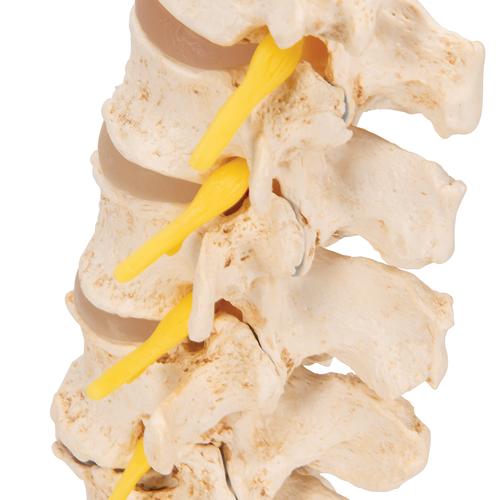퇴행성 요추와 추간판탈출증 모형 Stages of disc prolapse and vertebral degeneration - 3B Smart Anatomy, 1000158 [A795], 척추뼈 모형